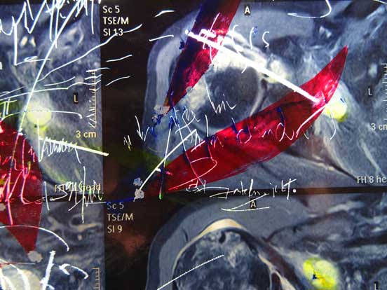 Walter Stach: for Jochen. 2016. Reworked x-ray. Detail